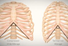 Wide Rib Cage